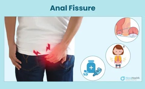 Anal Fissure - Symptoms, Causes, Diagnosis & Treatment